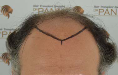 antes treatment 4