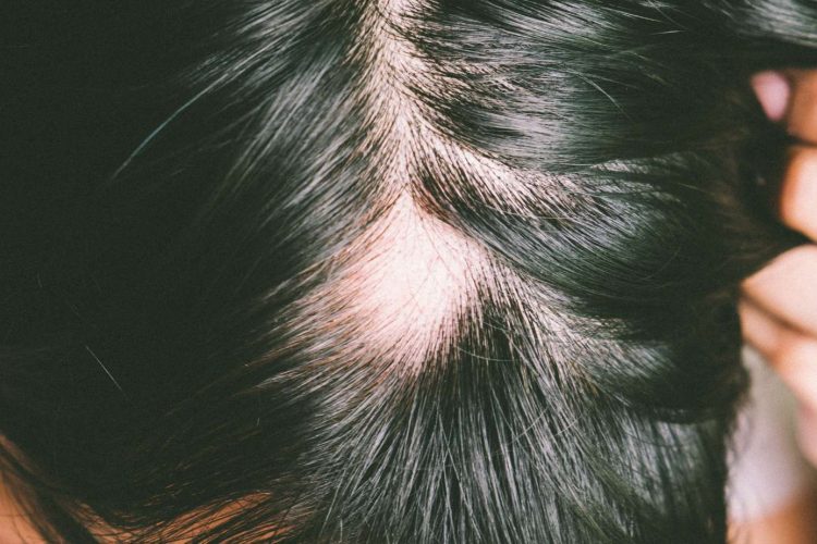 Alopecia-areata-¿-Que-es-y-como-tratarla-?