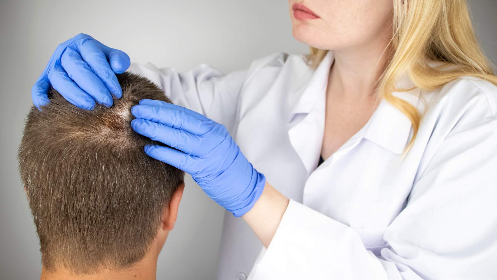 Alopecia-prematura