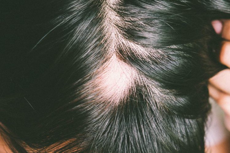 Parches-sin-cabello-¿-alopecia-?